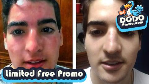 [Free Promo] Acne: Effective Solution from the Root